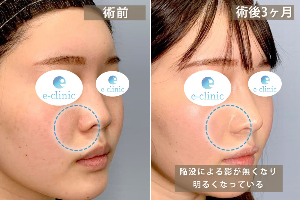 斜めから見た3か月後の貴族手術の症例写真