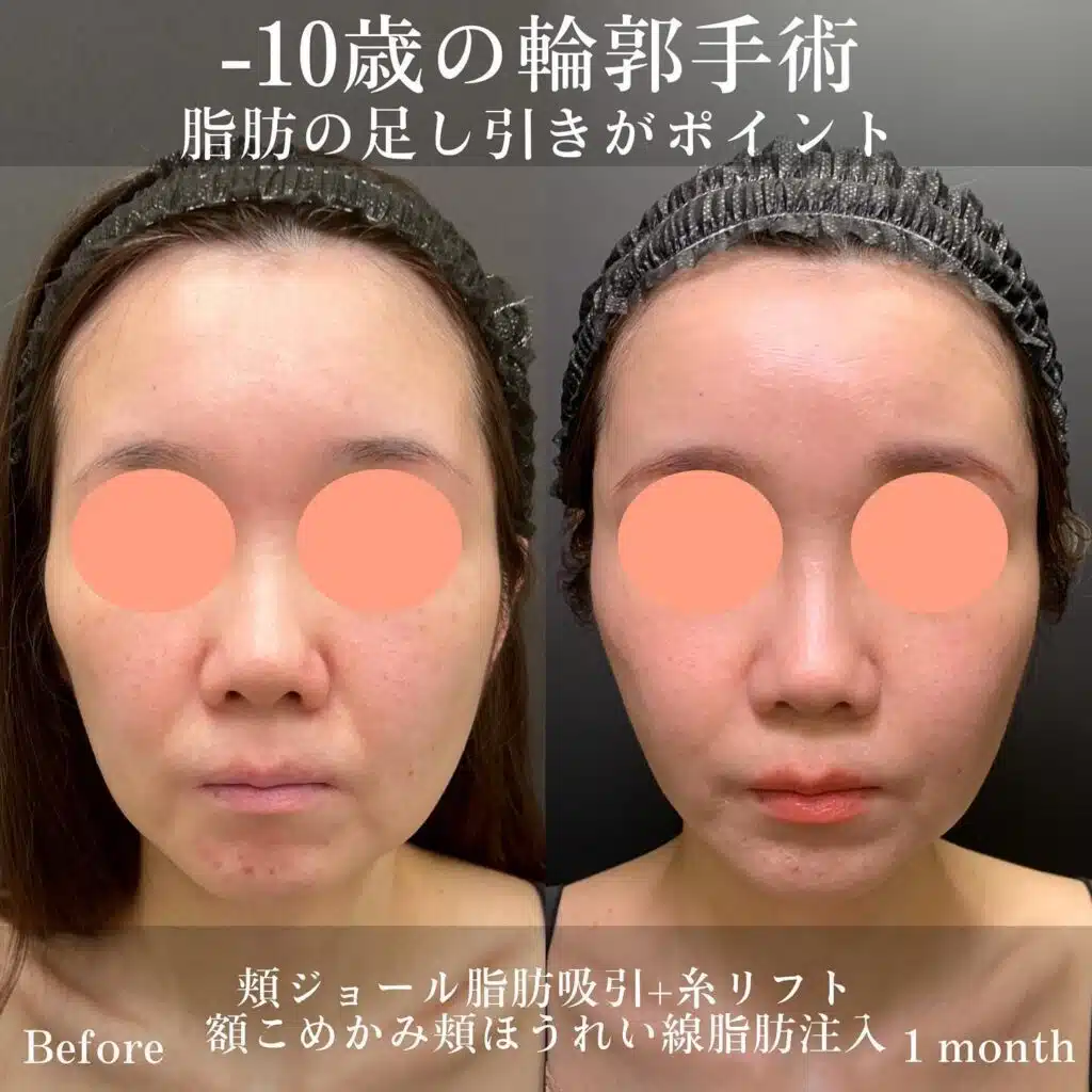 頬ジョール脂肪吸引+糸リフト　額こめかみほうれい線脂肪注入　新宿