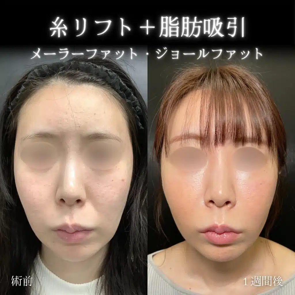 糸リフト＋脂肪吸引　新宿