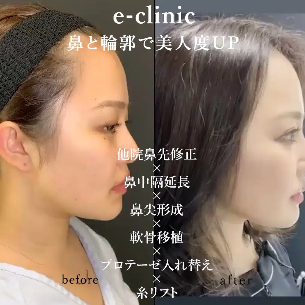 他院鼻先修正×鼻中隔延長×鼻尖形成×軟骨移植×プロテーゼ入れ替え×糸リフト 新宿
