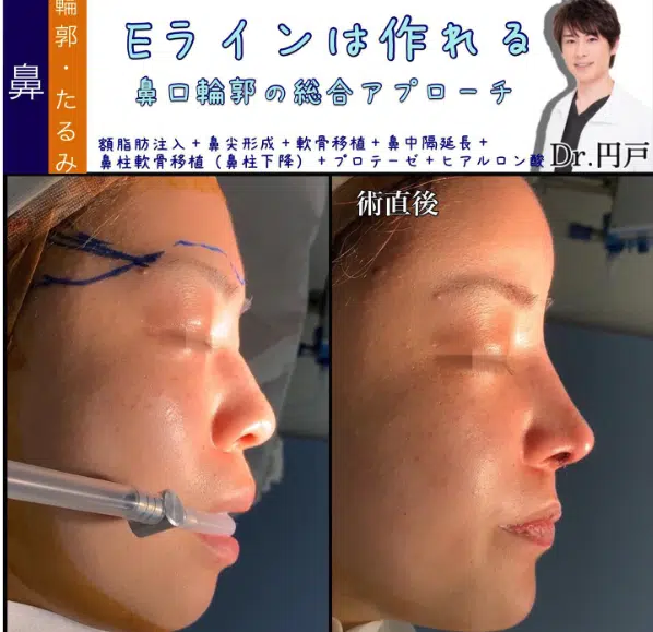 額脂肪注入+鼻尖形成+軟骨移植+鼻中隔延長+鼻柱軟骨移植(鼻柱下降)+プロテーゼ+ヒアルロン酸 新宿