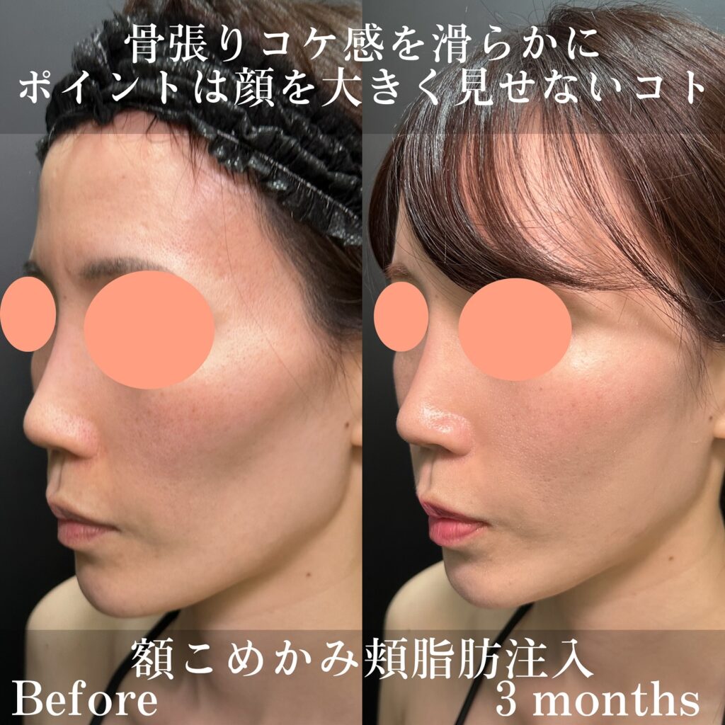 こめかみの脂肪注入の症例写真 (3)