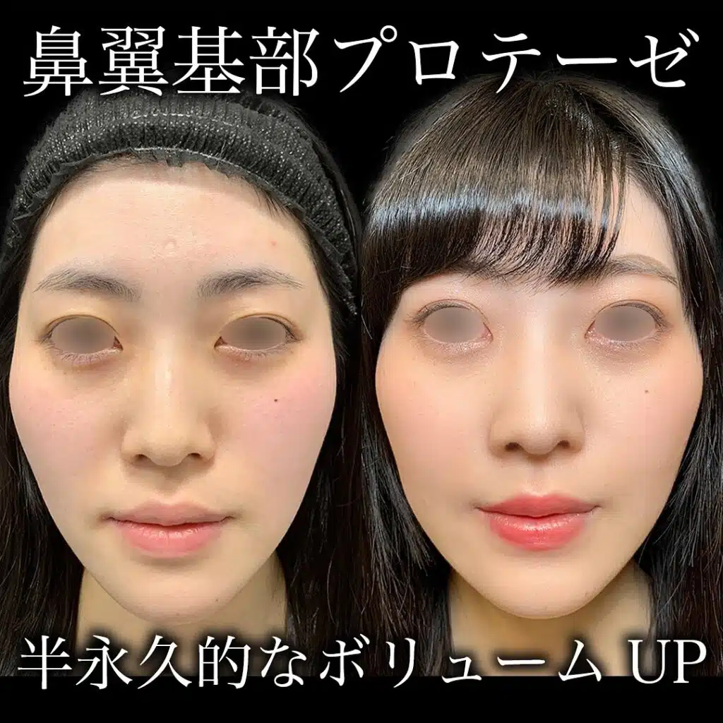 鼻翼基部プロテーゼ　新宿