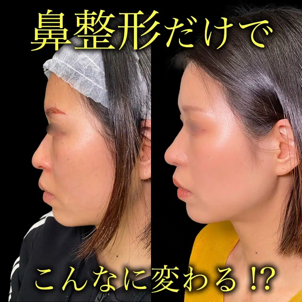 鼻尖形成と耳介軟骨移植と小鼻縮小 新宿