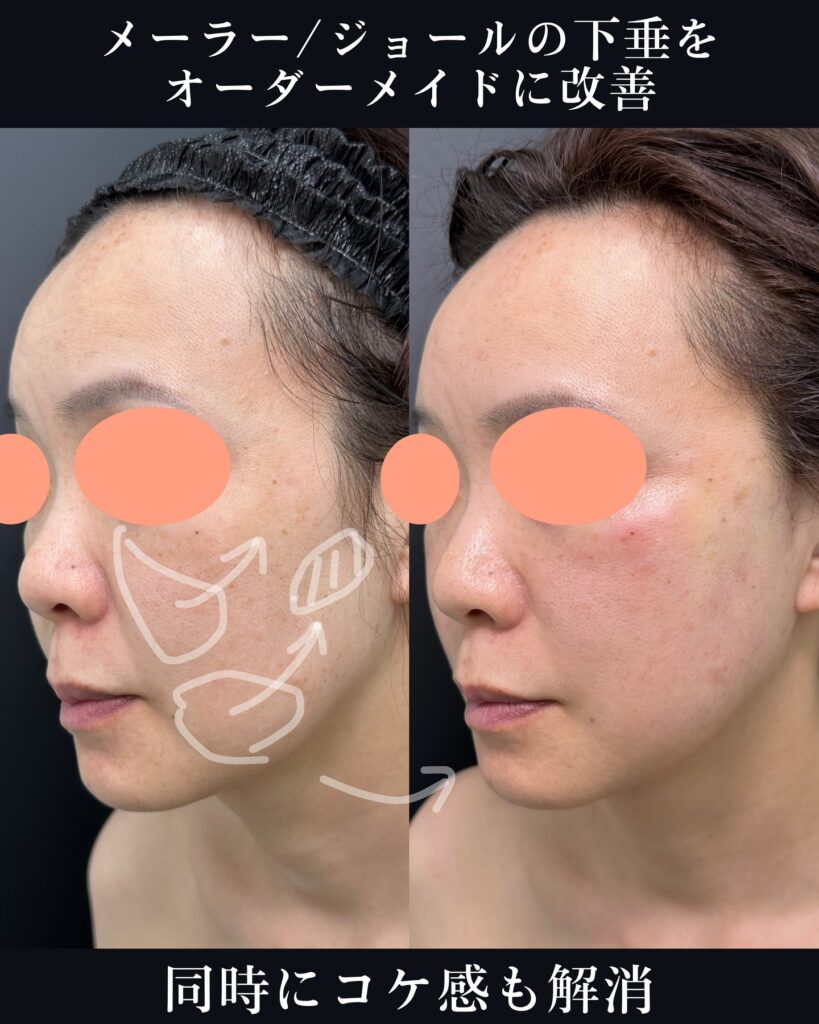 糸リフトの症例写真 (2)
