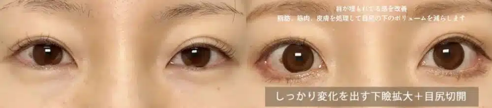 しっかり変化を出す下瞼拡大+目尻切開 新宿