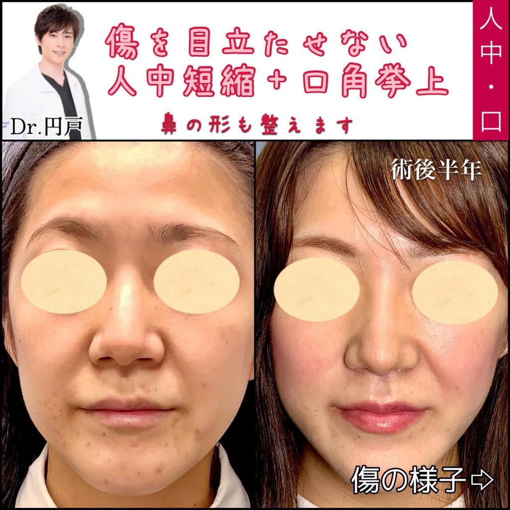 人中短縮術と口角挙上の症例 (1)