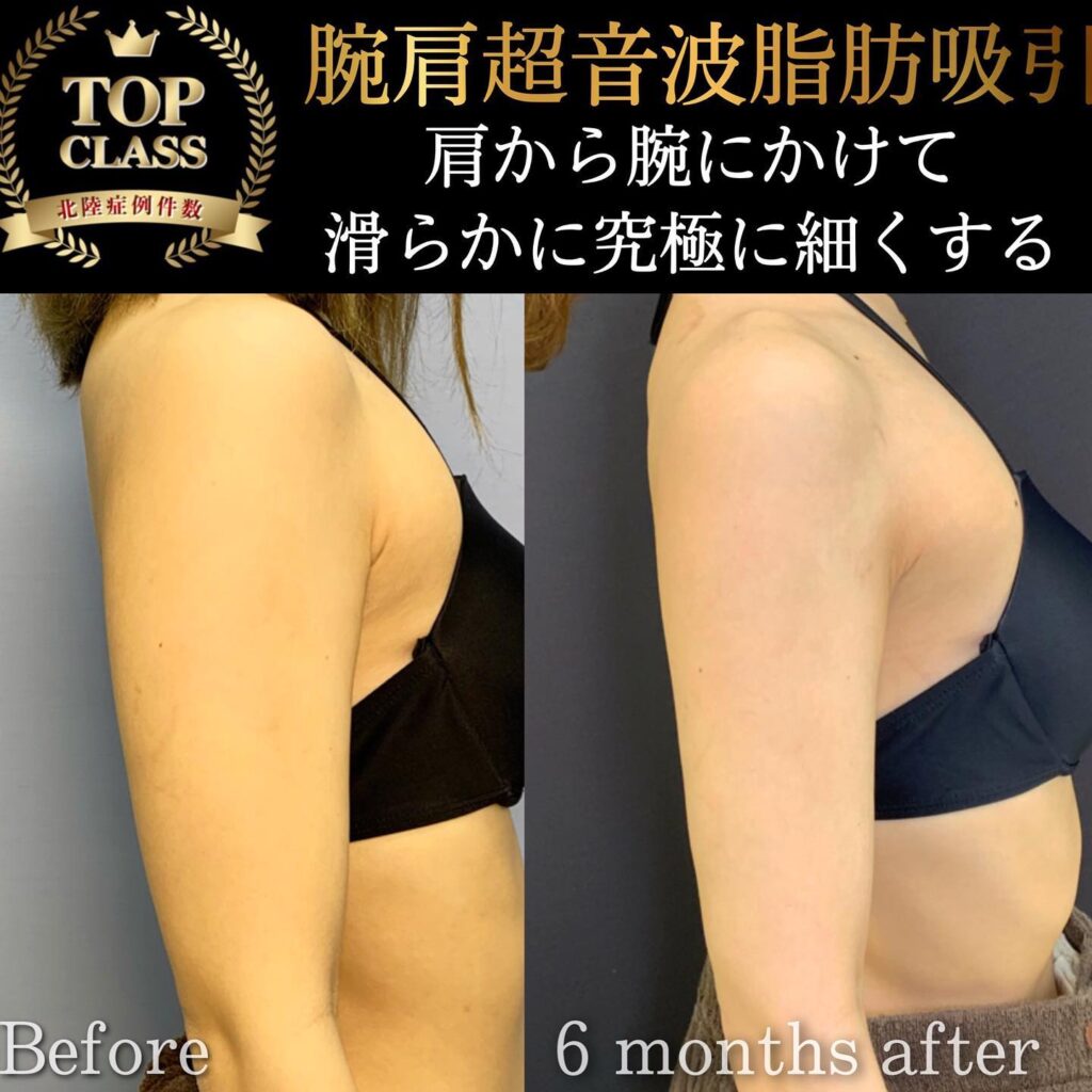 腕肩背中の症例写真