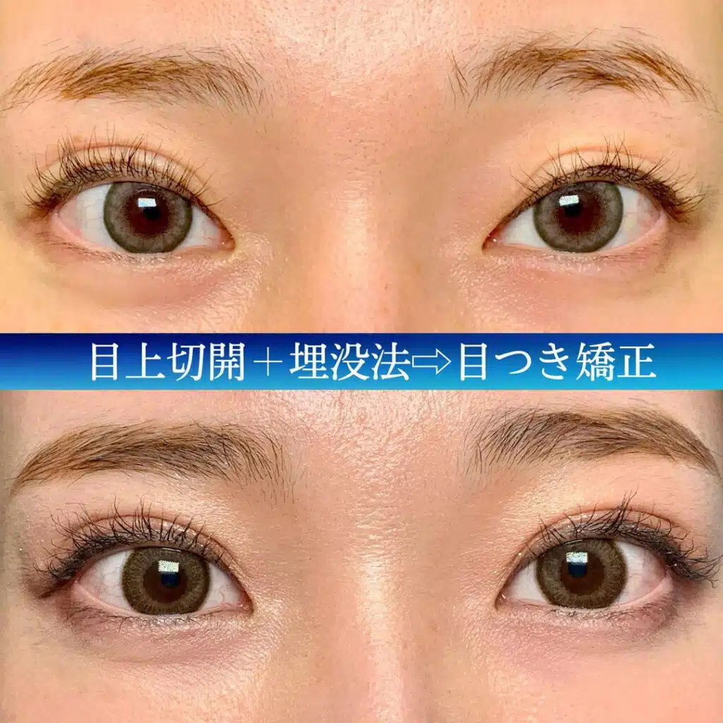 目上切開+埋没法　新宿