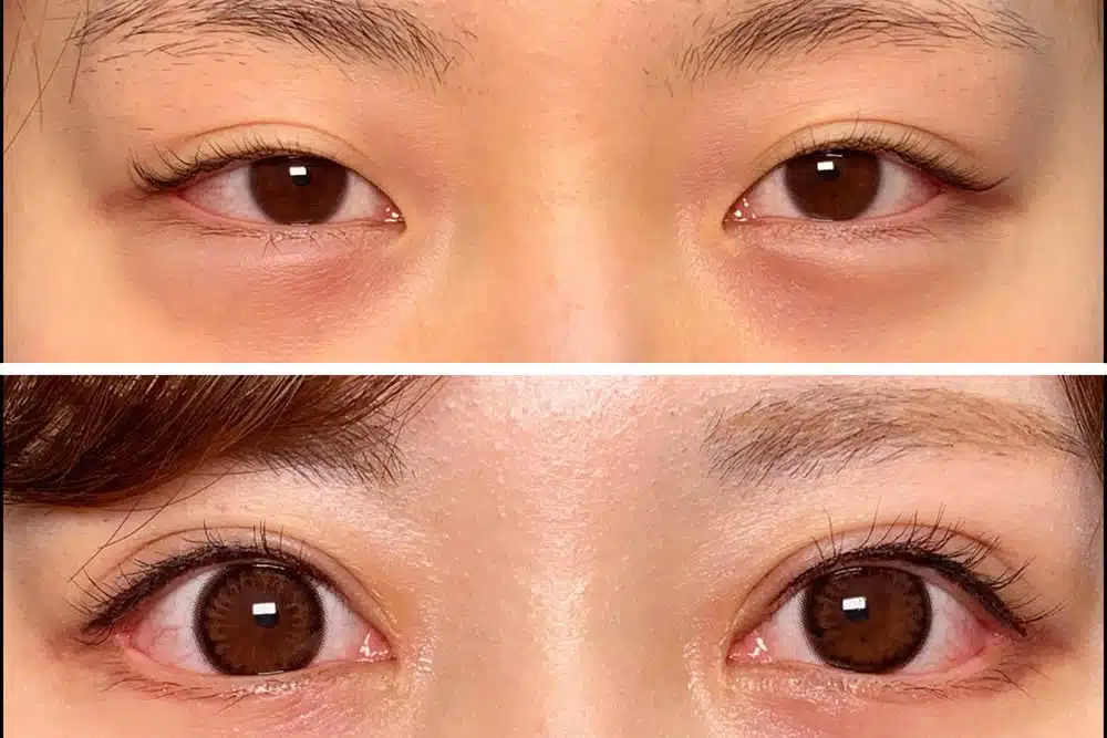 目尻切開+目頭切開 新宿