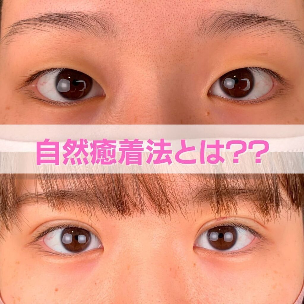自然癒着法の症例写真 (6)