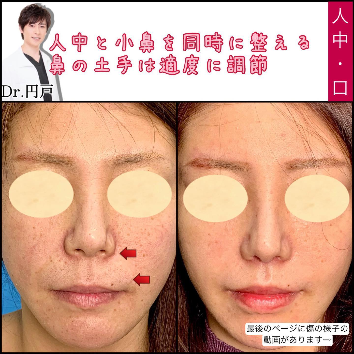 人中短縮と小鼻縮小と口角挙上と法令線人口真皮挿入と額こめかみ脂肪注入の症例写真 (2)