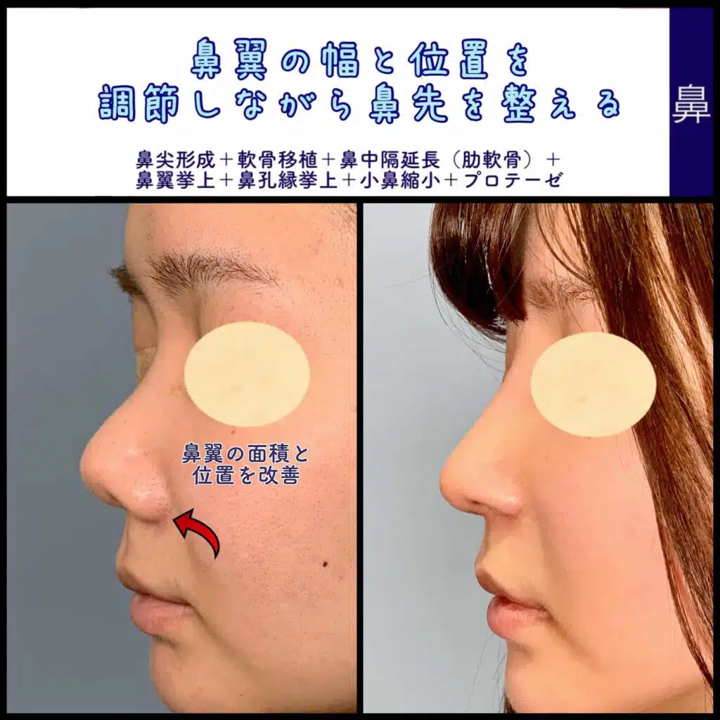 鼻尖形成+軟骨移植+鼻中隔延長(肋軟骨)+鼻翼挙上+鼻孔縁挙上+小鼻縮小+プロテーゼ 新宿