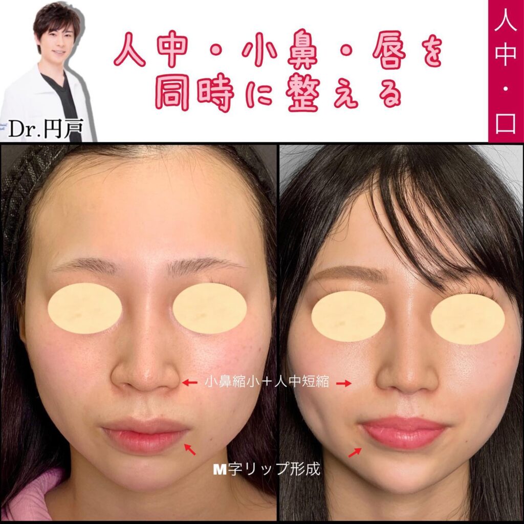 小鼻縮小と人中短縮とM字リップの症例写真 (2)