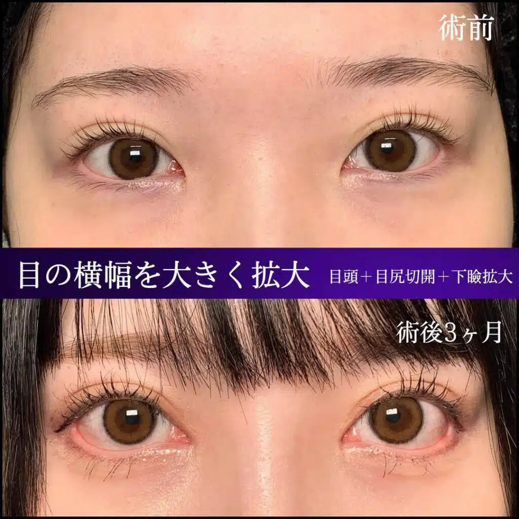 目頭+目尻切開+下瞼拡大 新宿