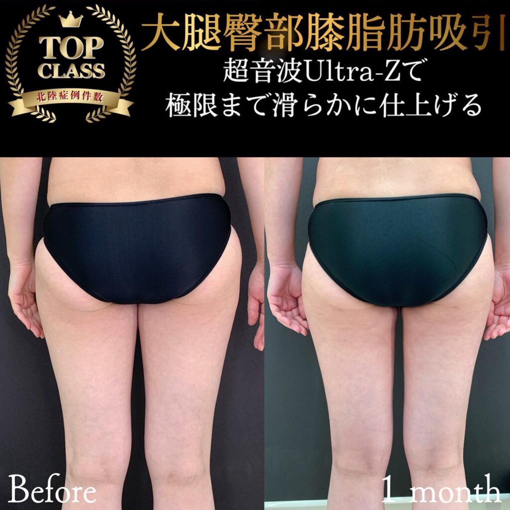 太ももの脂肪吸引の症例 (2)