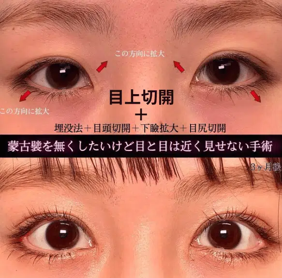 目上切開+埋没法+目頭切開+下瞼拡大+目尻切開　新宿