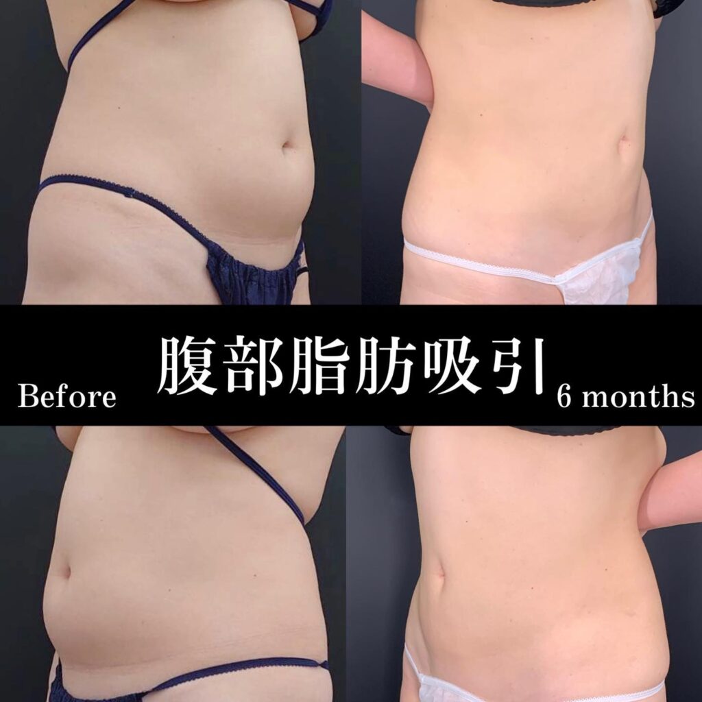 お腹の脂肪吸引 (1)