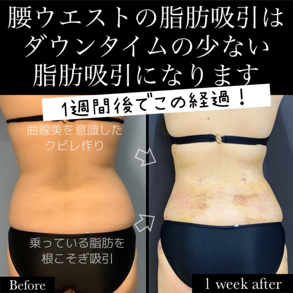 腰、お腹の脂肪吸引の症例 (2)