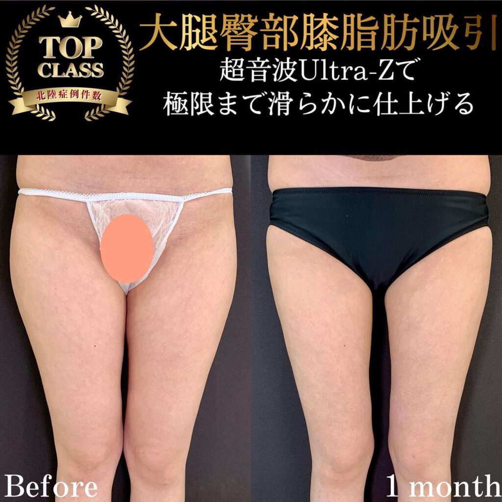 太ももの脂肪吸引の症例 (1)