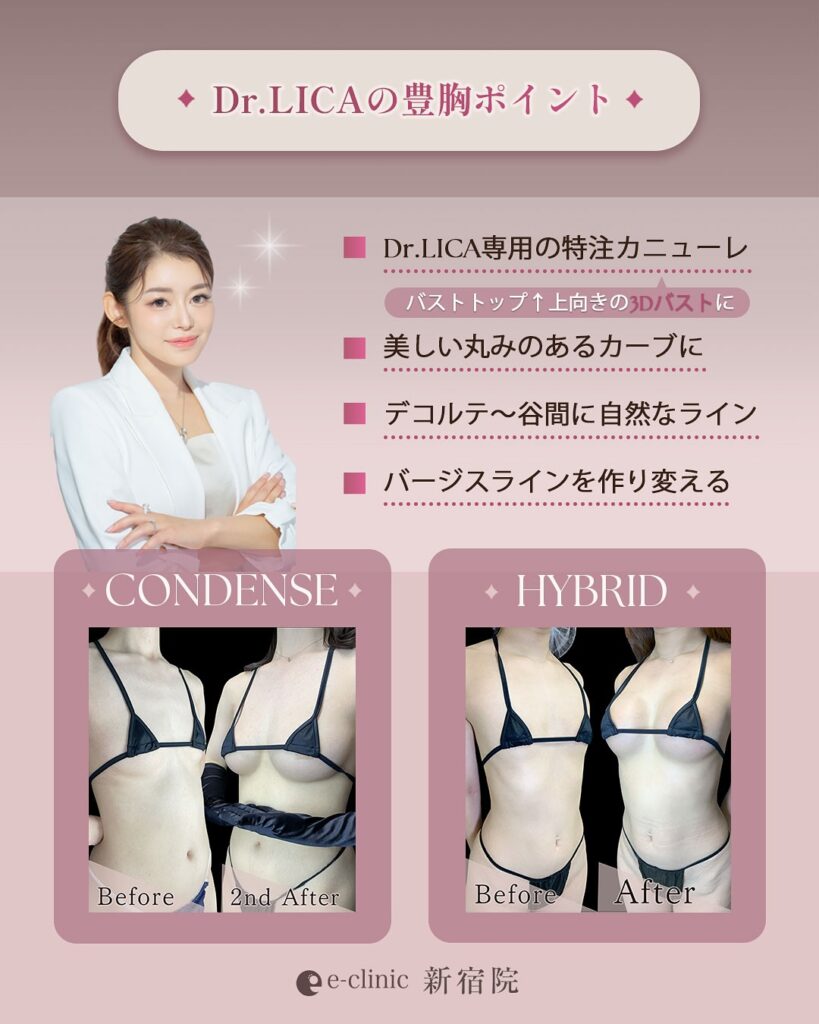 豊胸のポイントの紹介