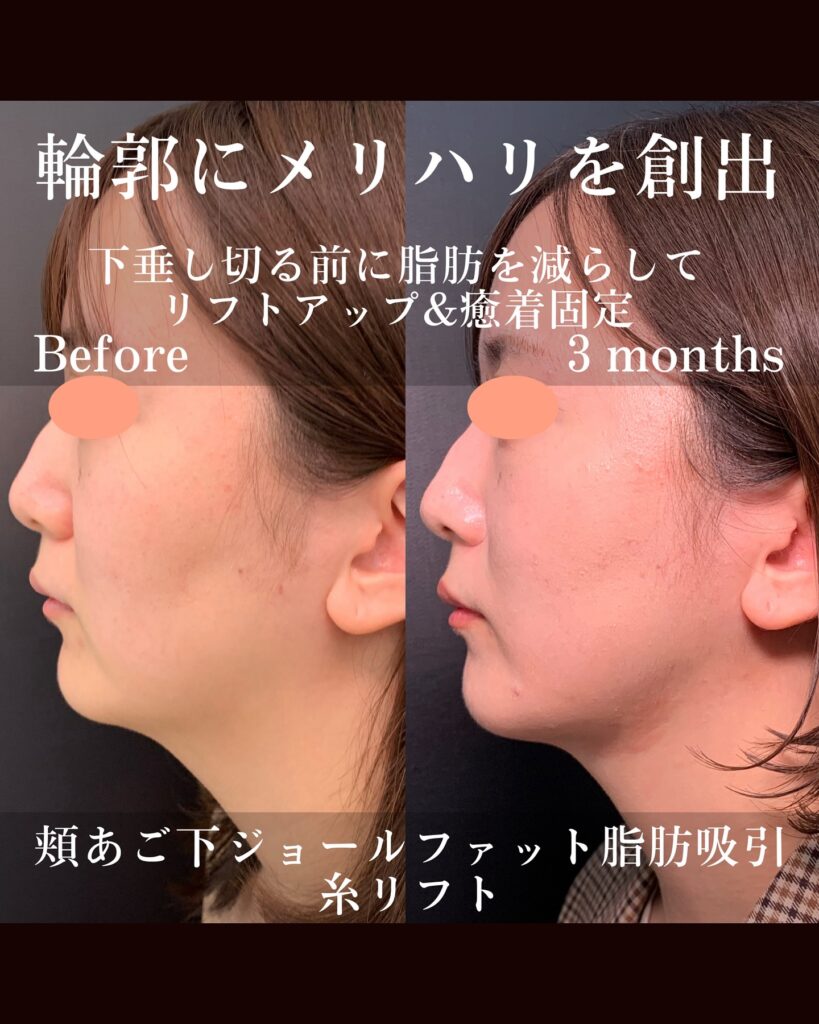 ジョールファットと糸リフトの症例写真 (1)