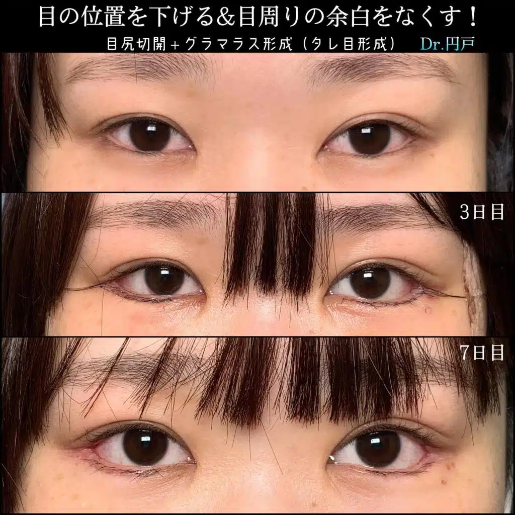 目尻切開+グラマラス形成(タレ目形成) 新宿