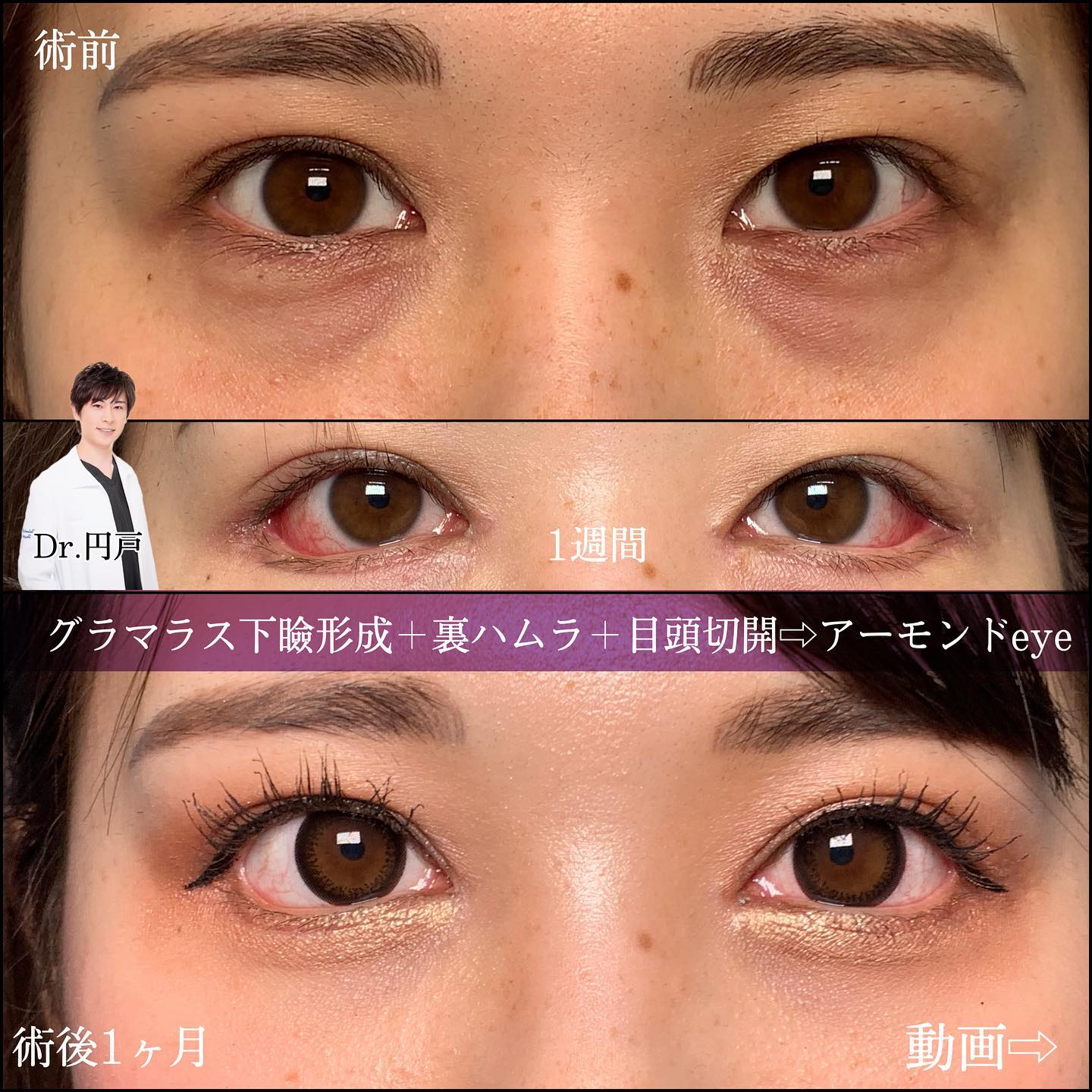 グラマラスライン形成と目頭切開と裏ハムラ法の症例写真
