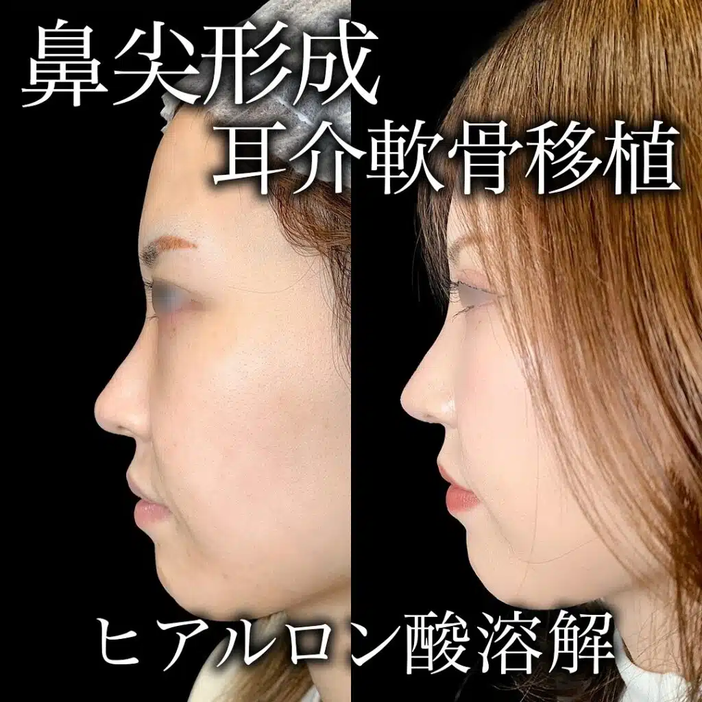 鼻尖形成と耳介軟骨移植 新宿
