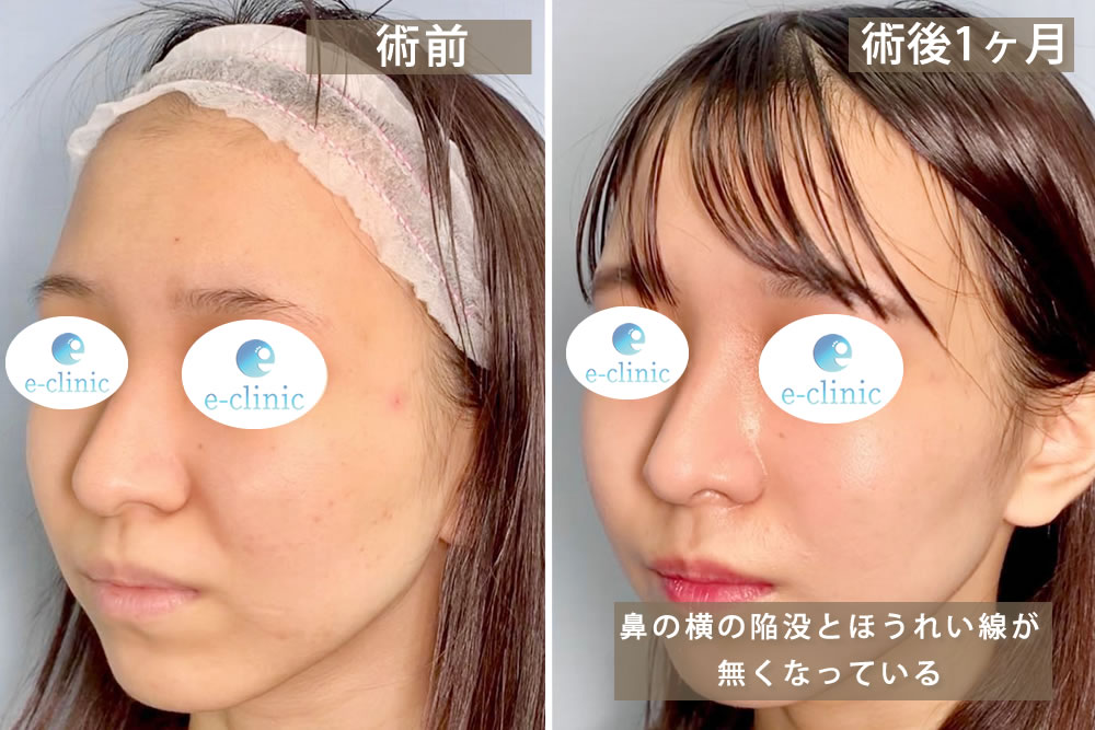 人工真皮の貴族手術と小鼻縮小を併用した1か月後の症例写真の斜め