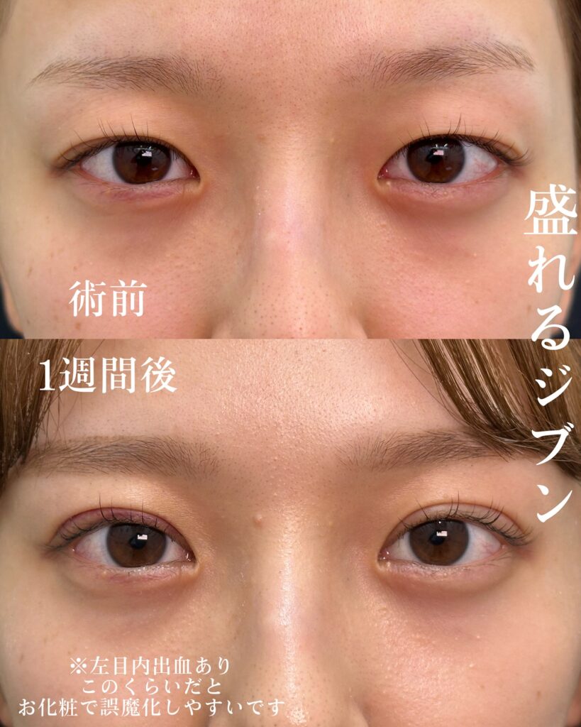 自然癒着法の症例写真 (1)