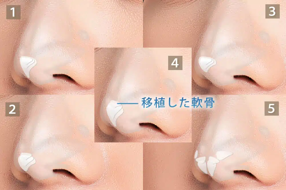 鼻尖軟骨移植の5つのパターン 新宿