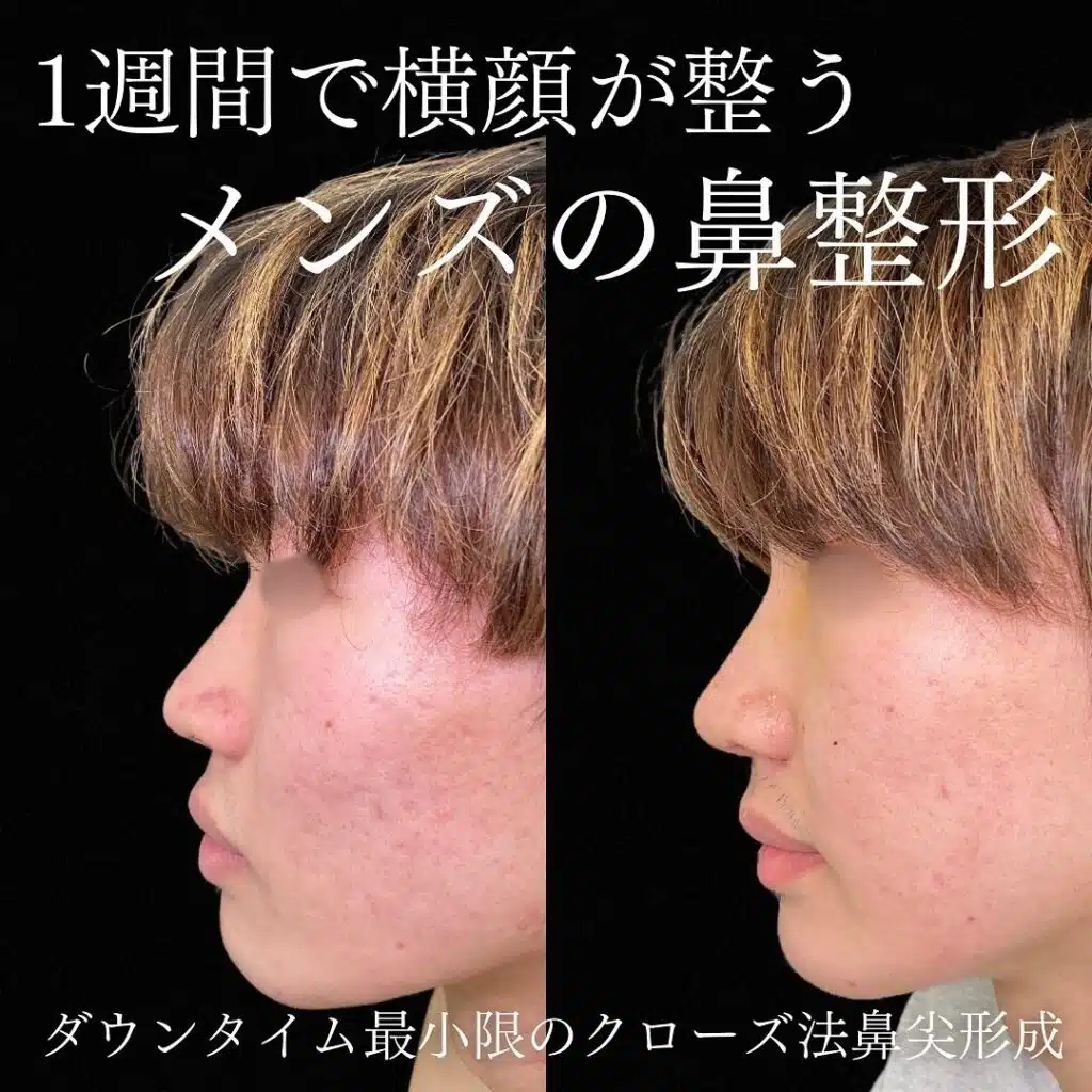 クローズ法鼻尖形成 新宿