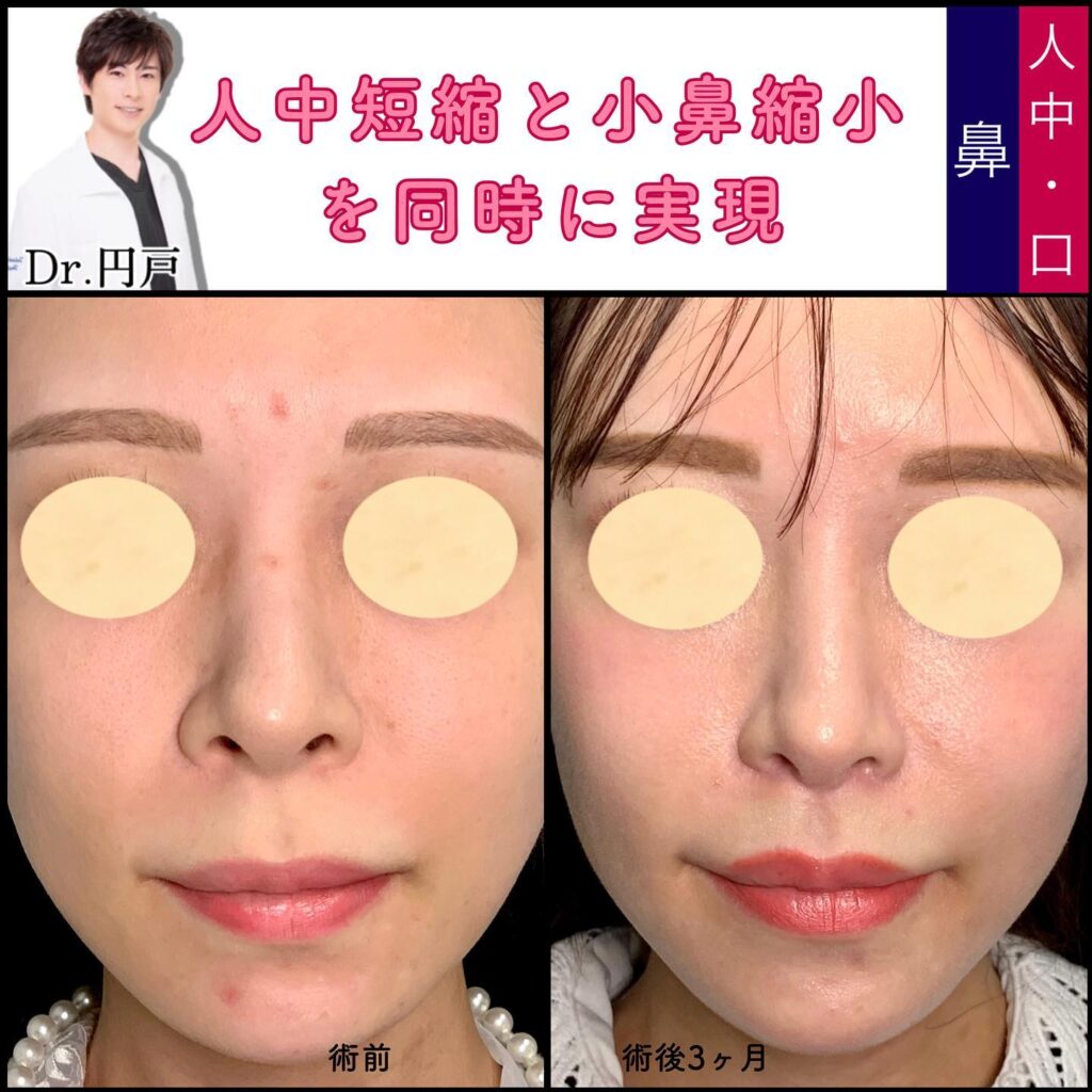 人中短縮と小鼻縮小の症例写真 (4)