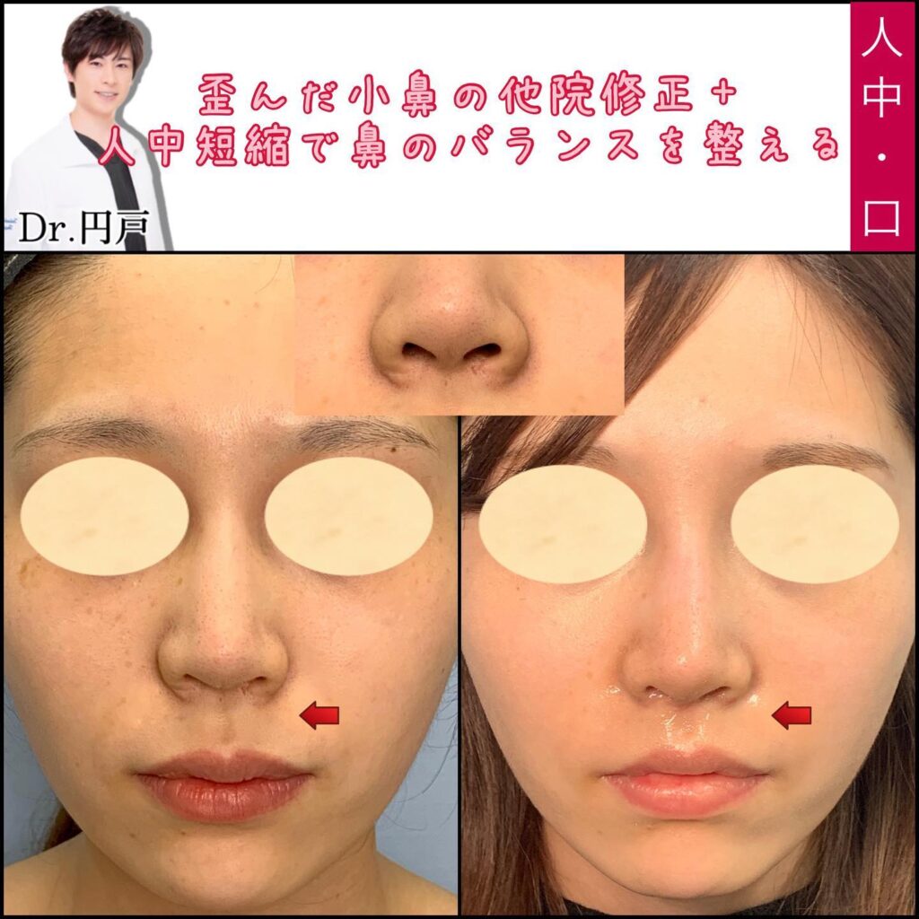 人中短縮と小鼻の縮小の他院修正の症例写真