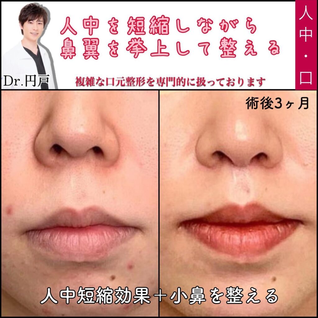 人中短縮と小鼻縮小の症例写真