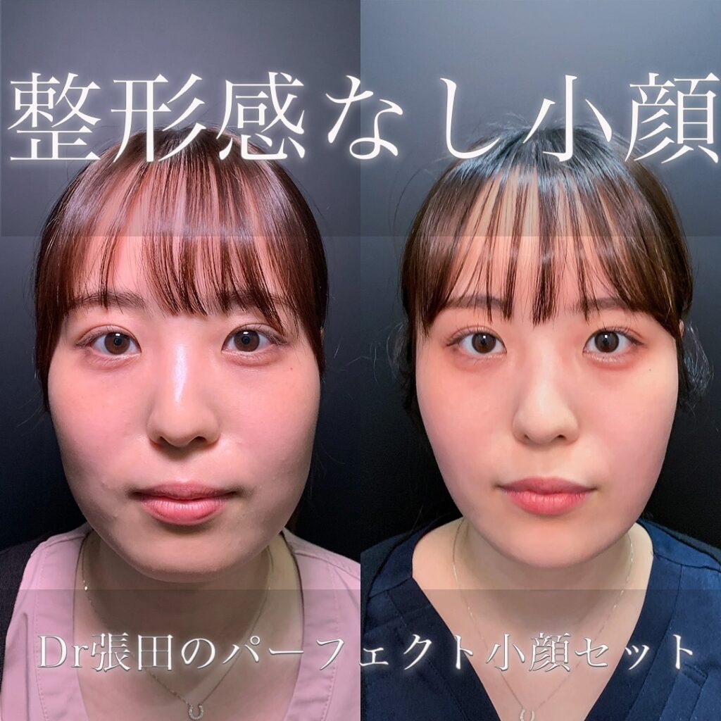 小顔脂肪吸引と糸リフトと脂肪注入の症例写真 (3)