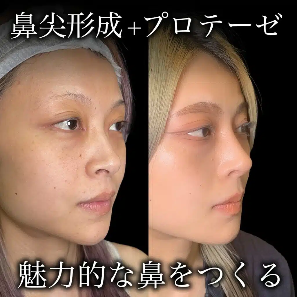 鼻尖形成+プロテーゼ 新宿