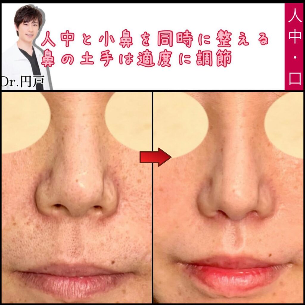 人中短縮と小鼻縮小と口角挙上と法令線人口真皮挿入と額こめかみ脂肪注入の症例写真 (1)