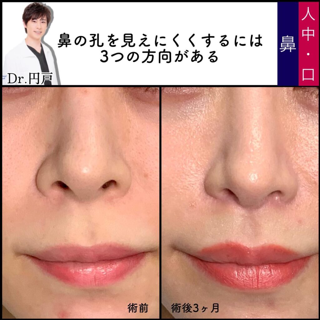 人中短縮と小鼻縮小の症例写真 (5)