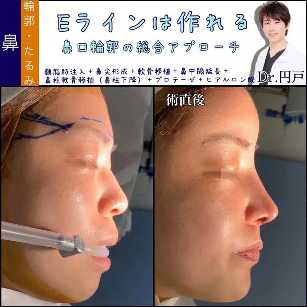 額脂肪注入+鼻尖形成+軟骨移植+鼻中隔延長+鼻柱軟骨移植(鼻柱下降)+プロテーゼ+ヒアルロン酸 新宿