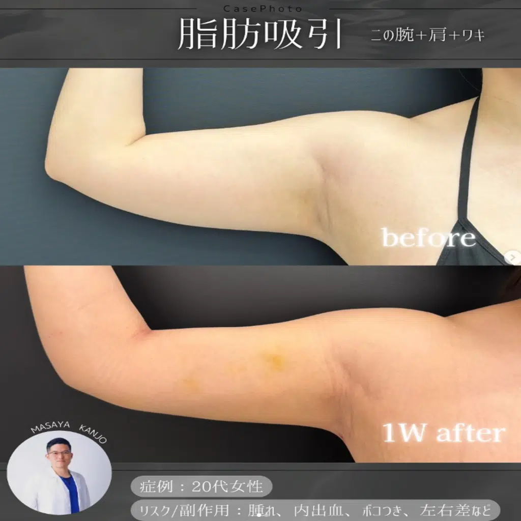 脂肪吸引 二の腕+肩+ワキ 新宿
