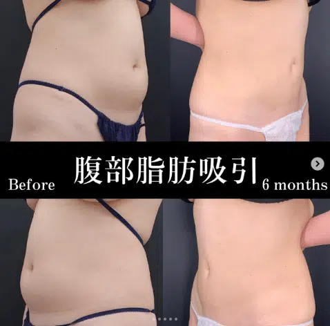 腹部脂肪吸引　新宿