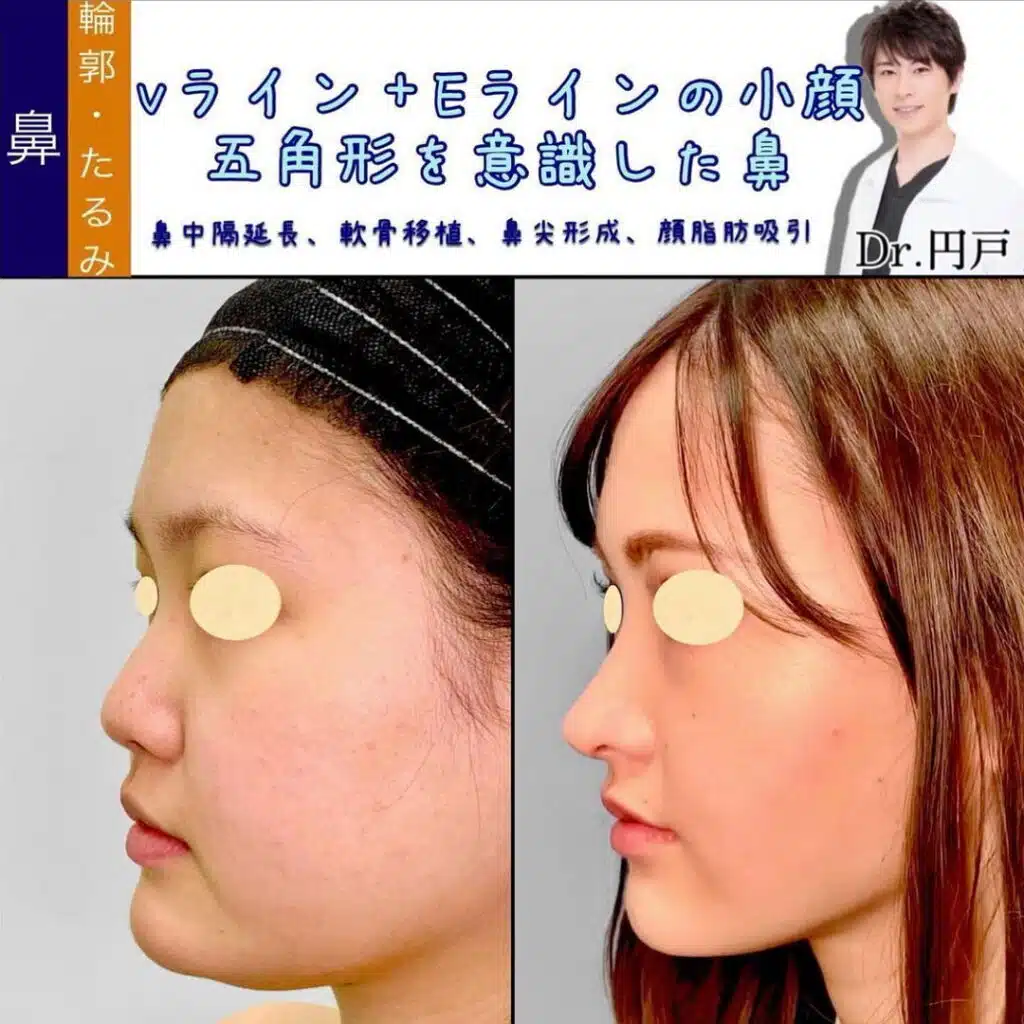 鼻中隔延長、軟骨移植、鼻尖形成、顔脂肪吸引 新宿