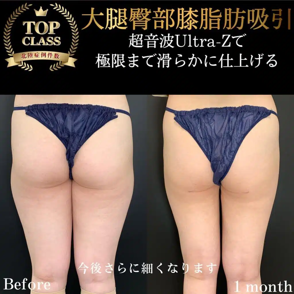 大腿臀部膝脂肪吸引 新宿