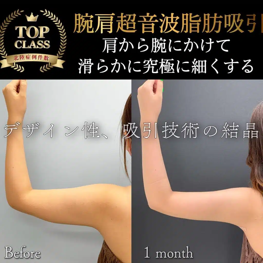腕肩超音波脂肪吸引 新宿
