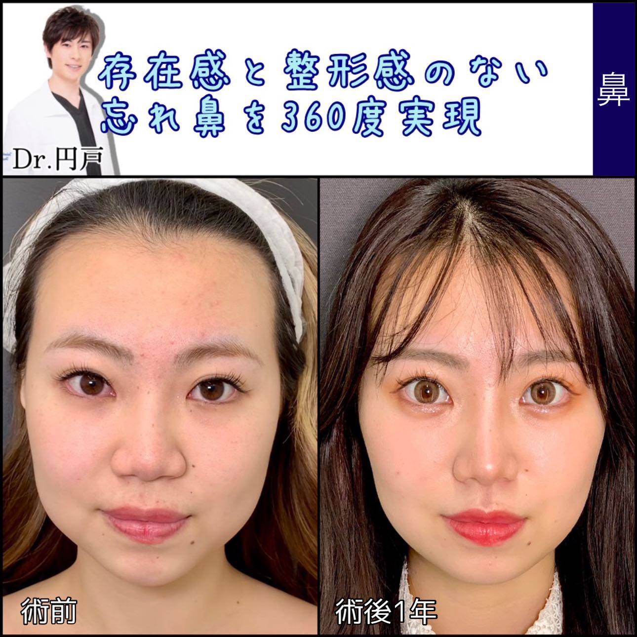 忘れ鼻の症例写真