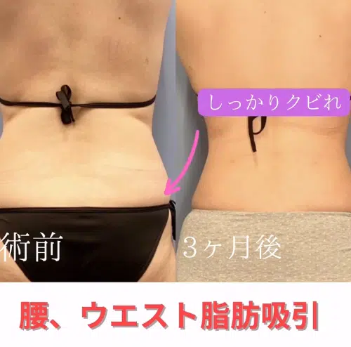 腰、ウエスト脂肪吸引　新宿