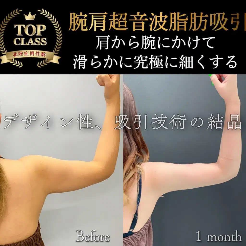 腕肩超音波脂肪吸引 新宿