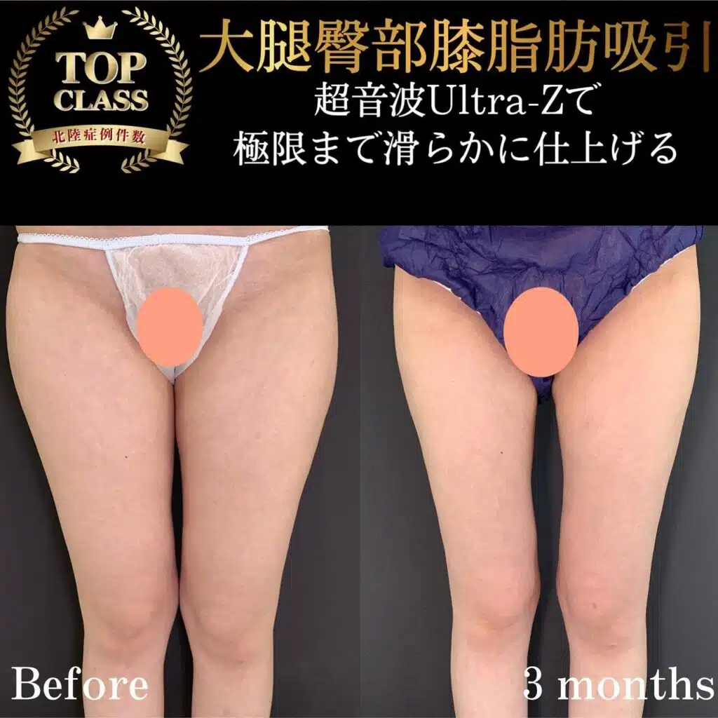大腿臀部膝脂肪吸引 新宿